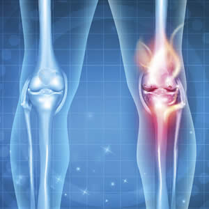 artrose em maringá fisioterapeuta maringa fisioterapia em maringa