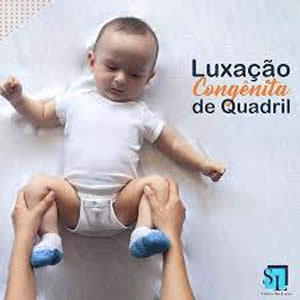 luxacao congenita quadril em maringá fisioterapeuta maringa fisioterapia em maringa