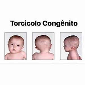 torcicolo congenito em maringá fisioterapeuta maringa fisioterapia em maringa